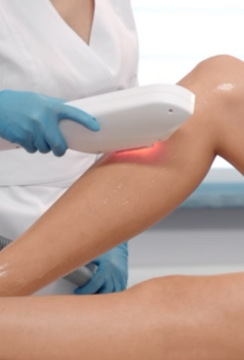 SHR Hair Removal